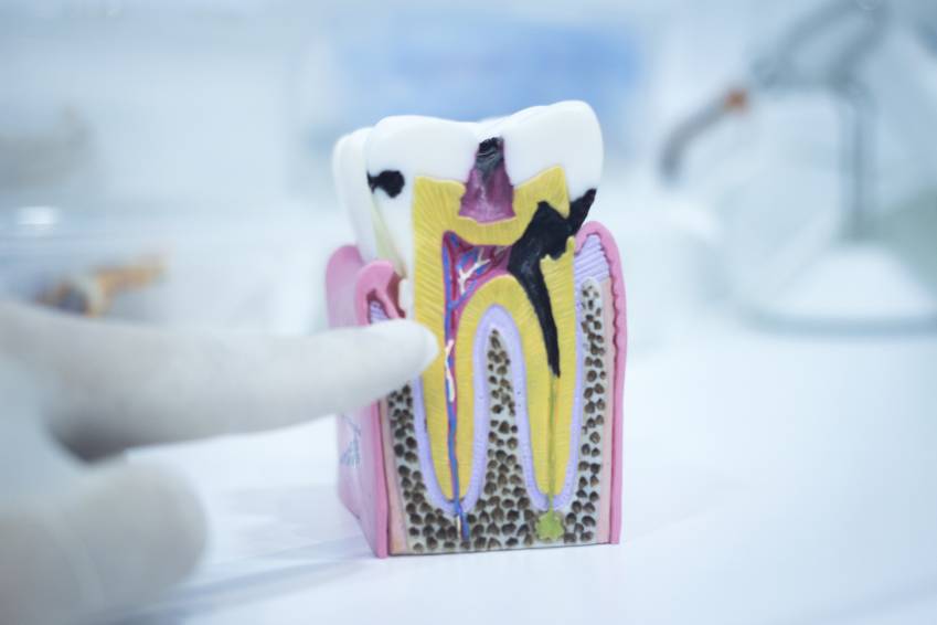 Dental Decay: Understanding and Preventing