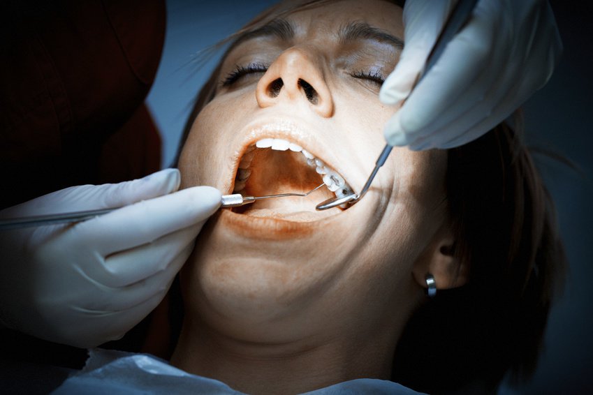 Dental Fillings: Everything You Need to Know About This Cosmetic Procedure